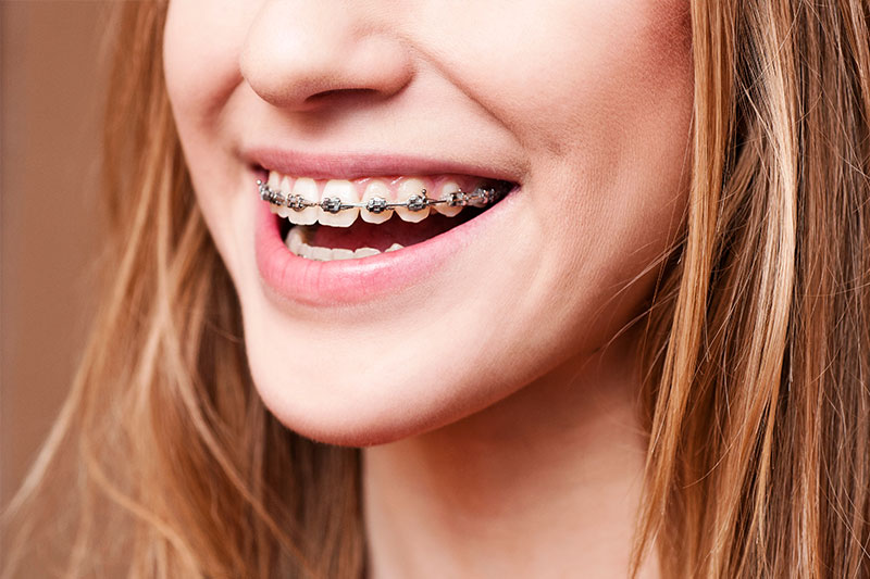 Orthodontics - Loreto R. Sicam, Jr., DMD, Inc., San Leandro Dentist